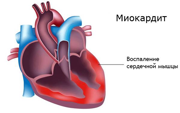 Ревматическая лихорадка (ревматизм)
