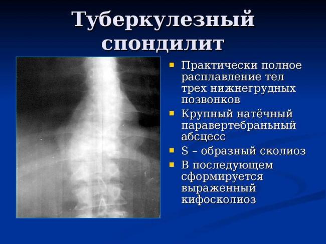 Спондилит поясничного отдела позвоночника что это такое