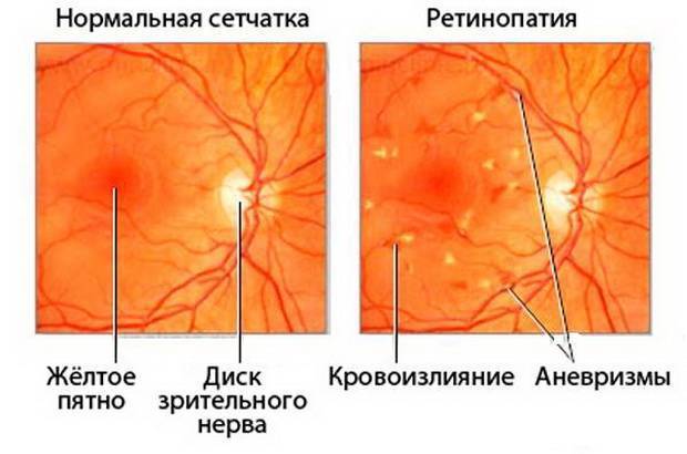 Изменение полей зрения