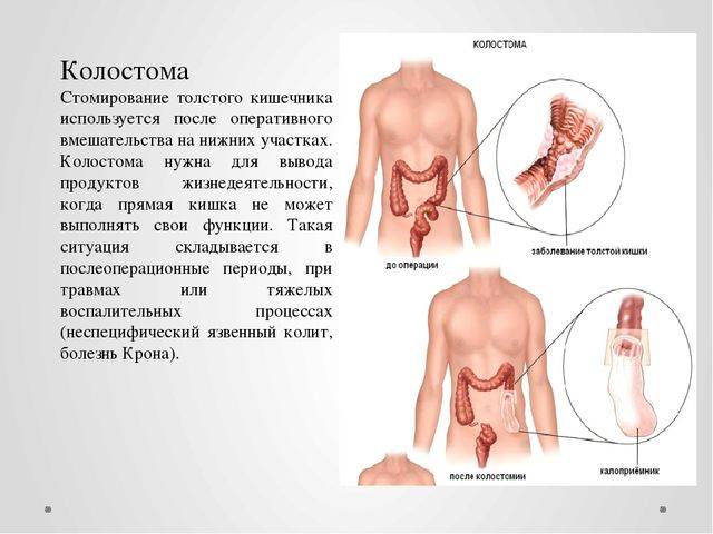 Питание при стоме прямой кишки | советы доктора