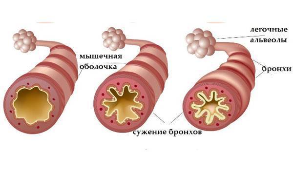 Деформирующий бронхит симптомы и лечение