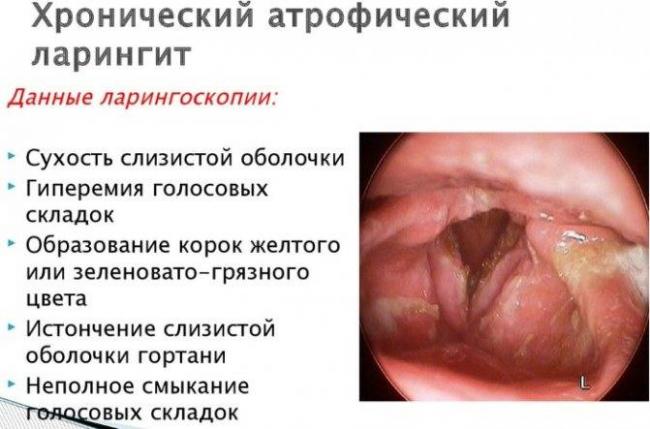 Ларинготрахеит симптомы и лечение у взрослых
