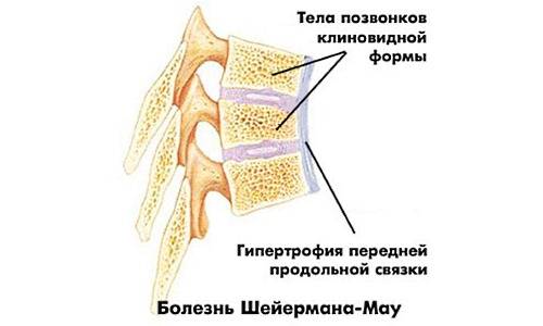 Кифоз грудного отдела позвоночника