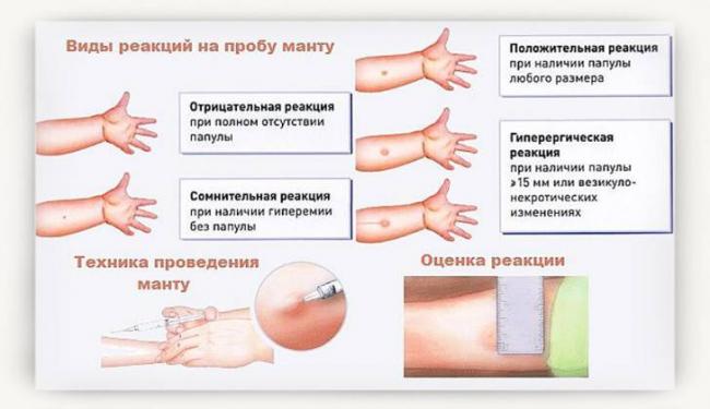 Побочные эффекты диаскитеста и что делать если они появились?