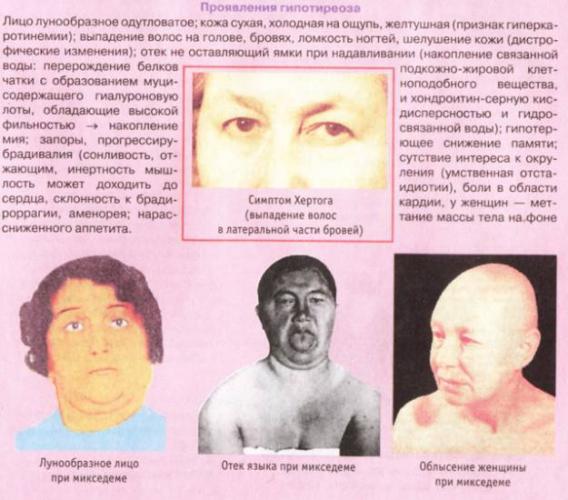 Гипотиреоз щитовидной железы: симптомы (у женщин, мужчин), лечение (препаратывитамины), диета, осложнения