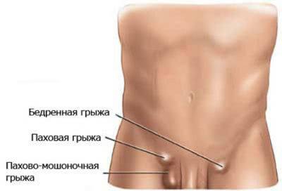Диагностика и лечение паховой грыжи у женщин