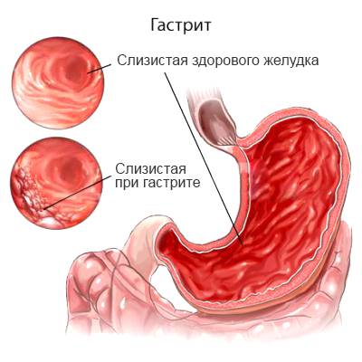 Болезнетворные бактерии — паразиты человека. где живут? какие вызывают болезни?
