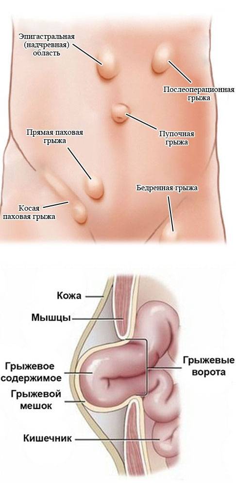 Лечение паховой грыжи в вопросах и ответах