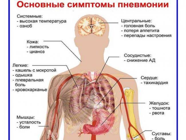 Признаки пневмонии у ребенка без температуры, но с кашлем – симптомы