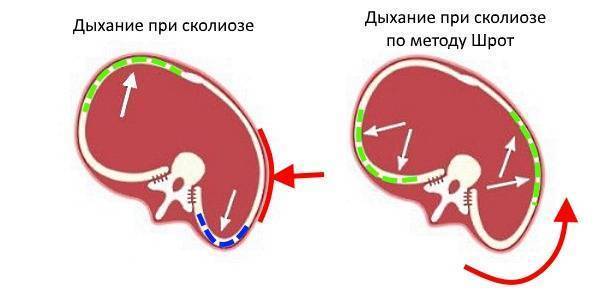 Дыхательная гимнастика шрот при сколиозе упражнения