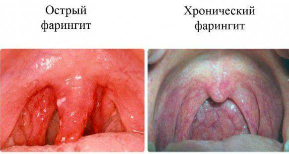 Что такое фарингит: симптомы воспаления глотки, лечение