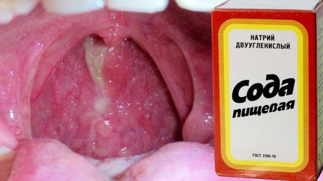 Острый фарингит: его симптомы и лечение у взрослых