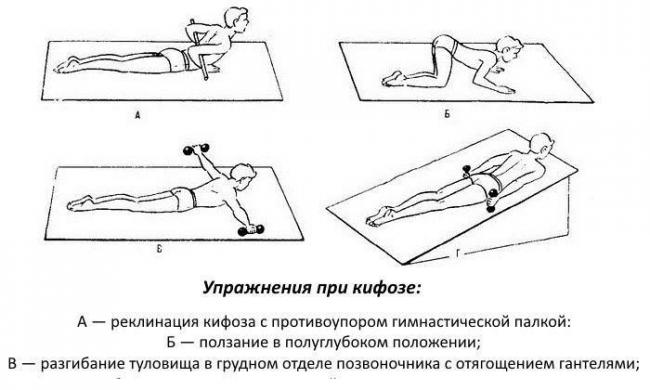 Кифоз грудного отдела позвоночника