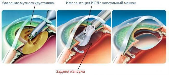 Что такое бельмо и катаракта? существуют ли в настоящее время способы лечения этих заболеваний?
