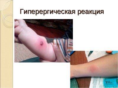 Температура после диаскинтеста: повлияет ли на результат?
