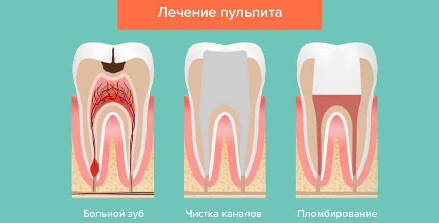 Современные зубные пломбы: виды, преимущества и недостатки каждого из видов