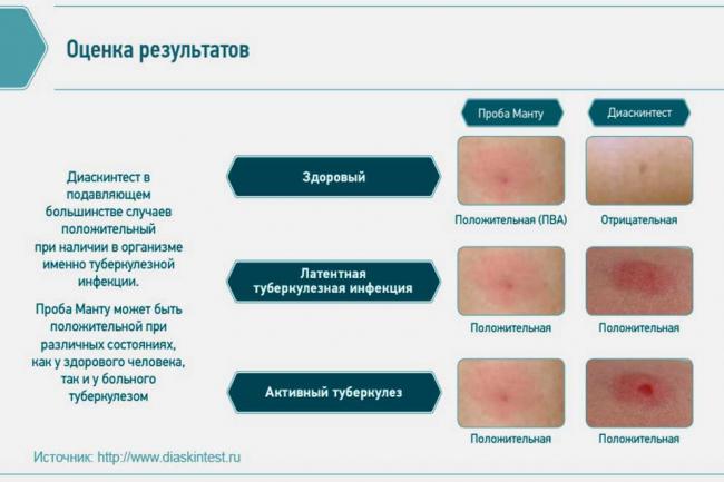 Диаскинтест во время простуды