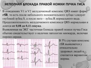 Блокада левой ножки пучка гиса полная и неполная: причины, симптомы и можно ли ее вылечить