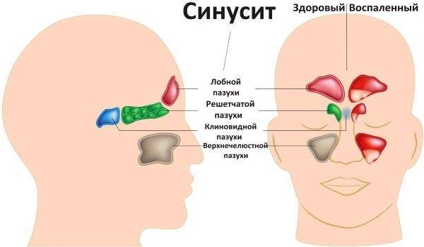 Респираторная микоплазменная инфекция у детей - симптомы болезни, профилактика и лечение респираторной микоплазменной инфекции у детей, причины заболевания и его диагностика на eurolab