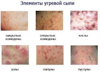 Высыпания на грудине у женщин фото