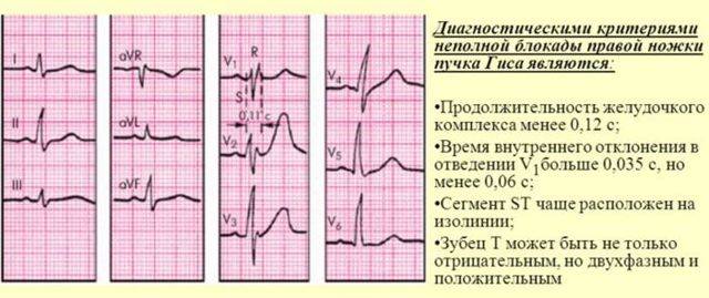 Неполная блокада правой ножки пучка гиса — что это такое, чем опасно?