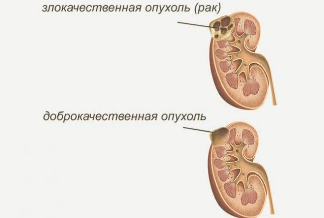 Протеинурия беременных: как справиться с патологией
