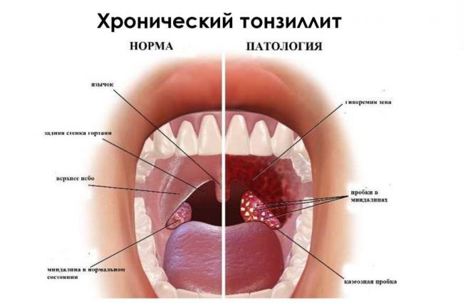 Острая ревматическая лихорадка: симптомы, лечение, профилактика