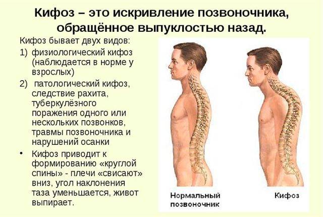 Лфк при кифозе грудного отдела позвоночника