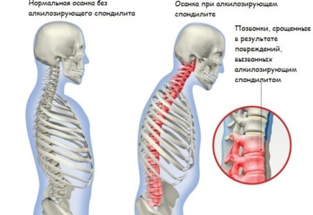 Спондилит поясничного отдела позвоночника: что это такое, симптомы и лечение воспаления