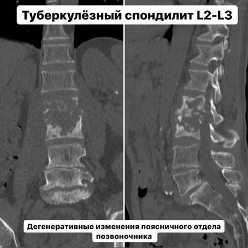 Туберкулезный спондилит (болезнь потта): диагностика, симптоматика и лечение