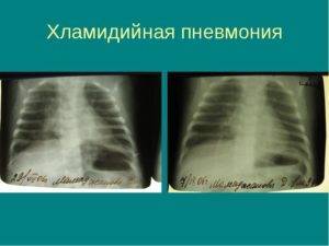 Микоплазма – пневмония микоплазменная у детей: симптомы и лечение