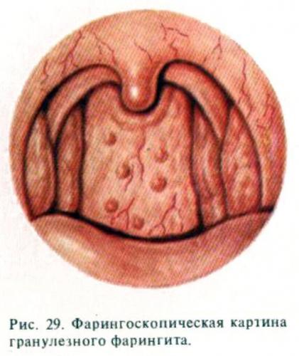 Обострение хронического фарингита симптомы и лечение