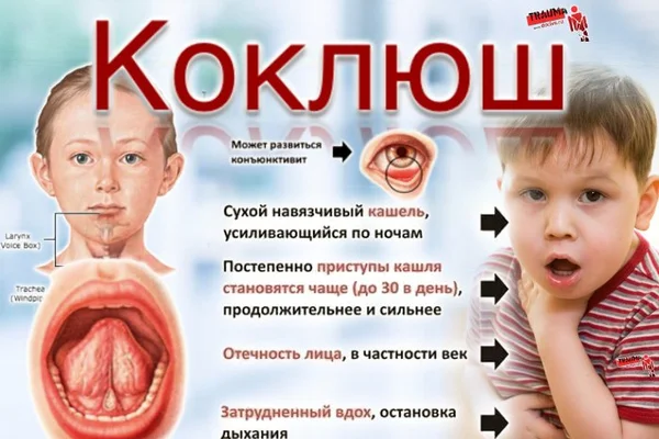 Коклюш - симптомы болезни, профилактика и лечение коклюша, причины заболевания и его диагностика на eurolab