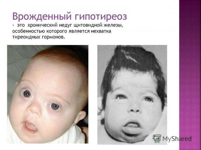 Лечение гипотиреоза