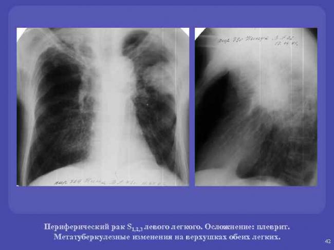 Последствия после перенесенного туберкулеза легких