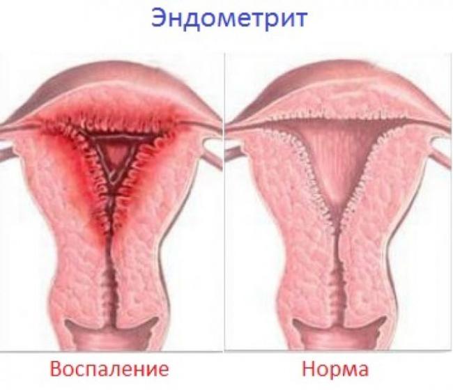 Эндометрит у женщин: что это такое, причины возникновения, симптомы, лечение, препараты, схемы