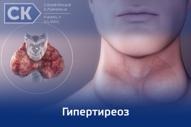Микседема: симптомы, причины, лечение, фото, диагностика, профилактика, прогноз