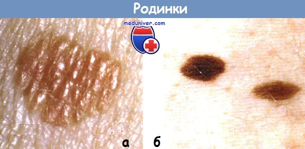 Опасные родинки (фото), виды родинок – папилломатозный, меланоформный, диспластический невус