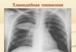 Причины микоплазменной пневмонии, характерные симптомы и принципы лечения