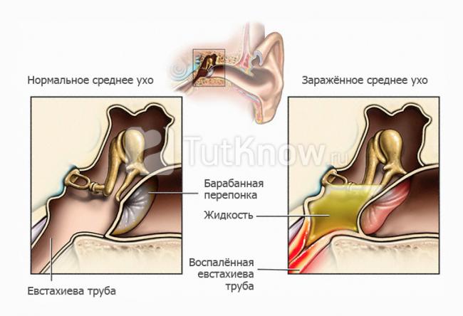 Болит ухо при простуде что делать