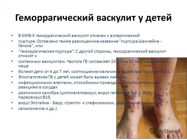 Тромбоцитопеническая пурпура у детей