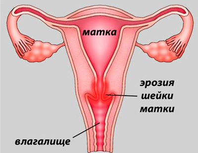 Фоновые и предраковые заболевания шейки матки