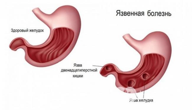 Язва желудка: симптомы и проявления у взрослых, лечение