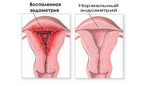 Эндометрит