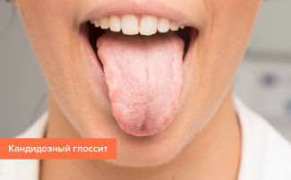 Глоссит: виды, симптомы, причины, лечение у взрослых