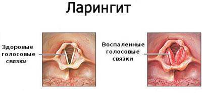 Лечение ларинготрахеита у взрослых препараты