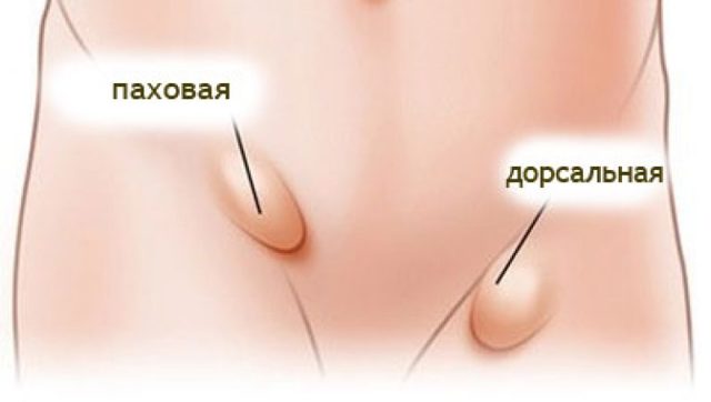 Клинические проявления паховой грыжи у мужчин