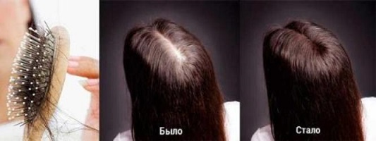 Очаговая алопеция — как лечить у женщин и мужчин