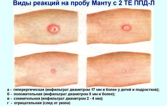 Как измерять манту