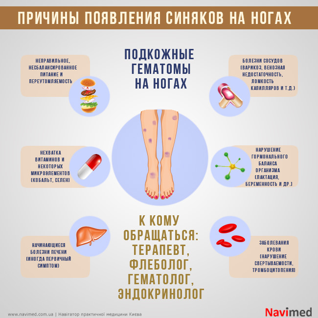 Почему появляются синяки на ногах без ударов, диагностика, прогноз